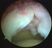 cierre_lado_lado_almazan